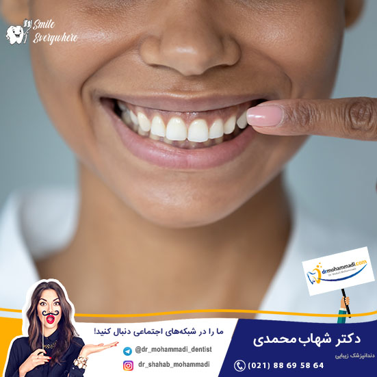 درباره باندینگ کامپوزیت دندان و مزایای آن برای اصلاح طرح لبخند بیشتر بدانید - کلینیک دندانپزشکی دکتر شهاب محمدی